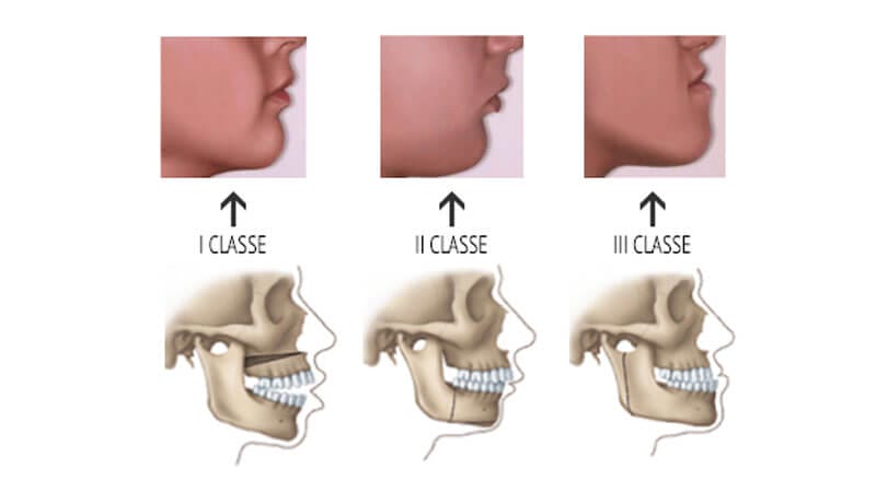 II Classe dento scheletrica
