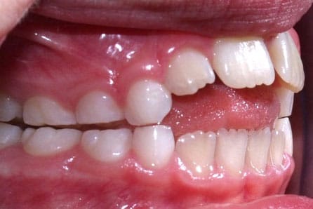 deglutizione-atipica