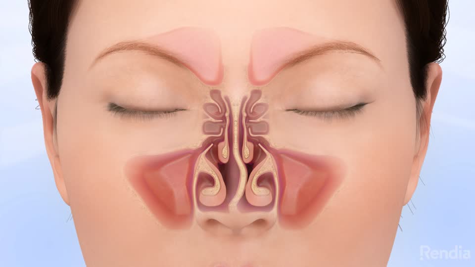 setto nasale deviato