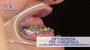 Decompensazione ortodontica