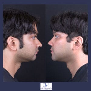 Face Masculinization Surgery