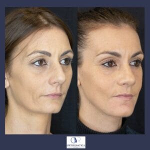 Femminilizzazione del volto - chirurgia maxillo facciale