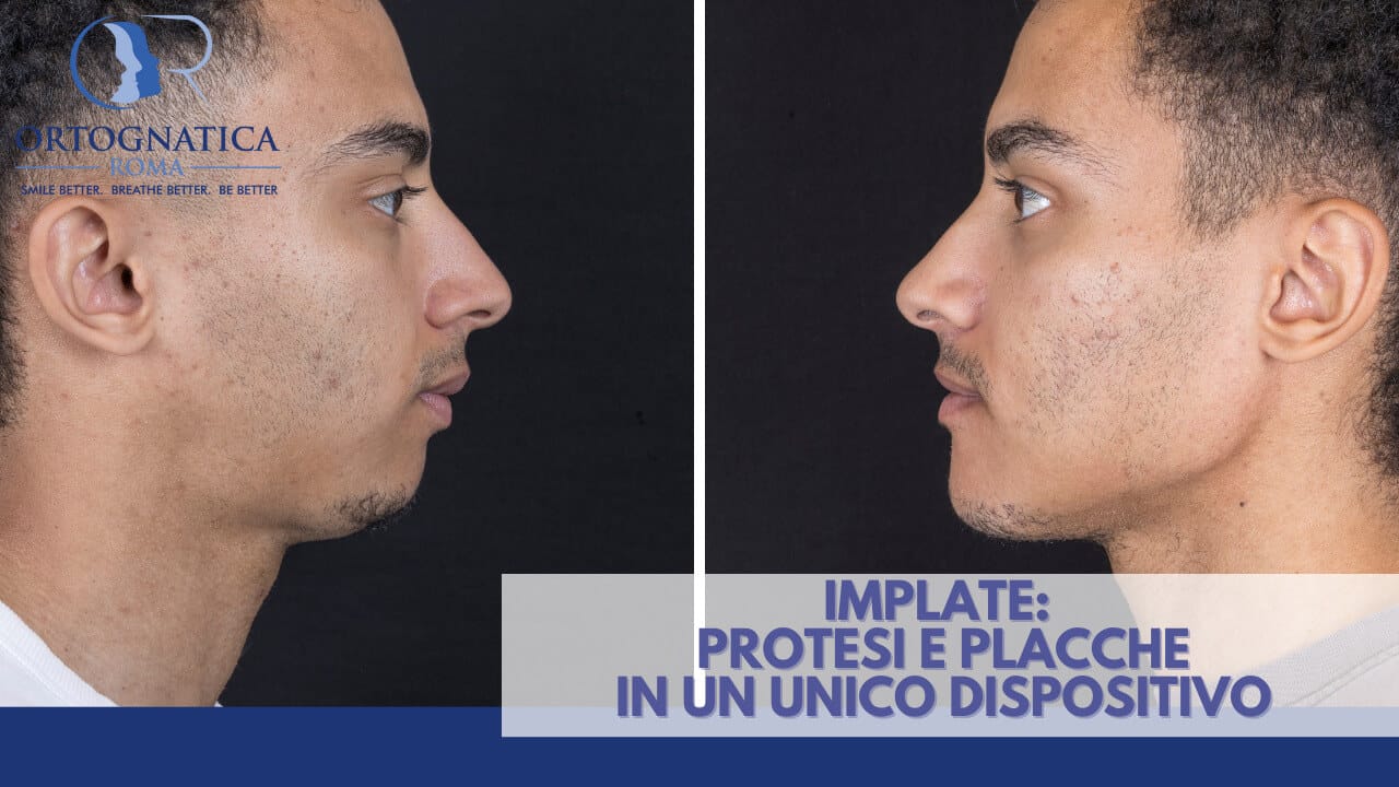 Implate Chirurgia Ortognatica