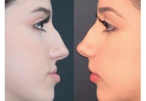 Terza classe Dento scheletrica esempio