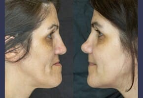 Terza classe dento scheletrica